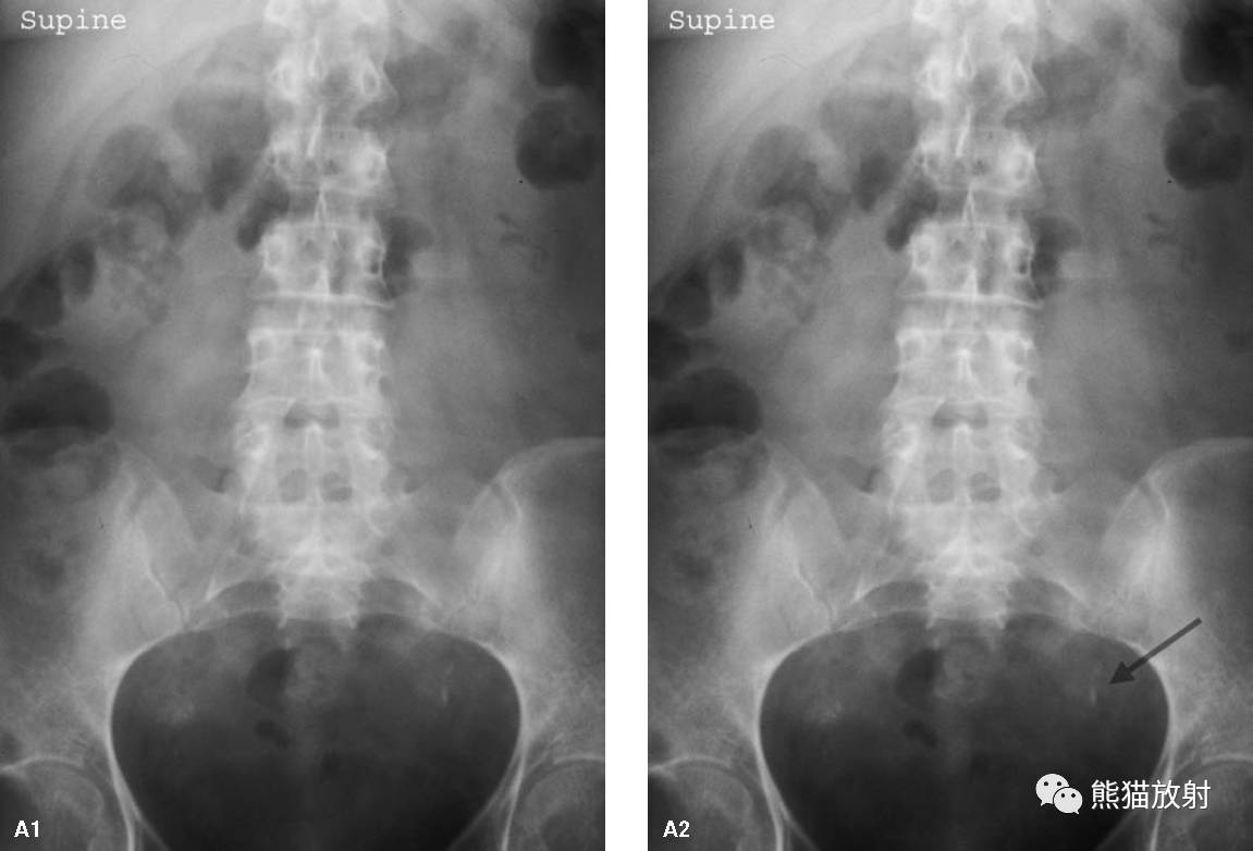 输尿管结石 ureteral stone