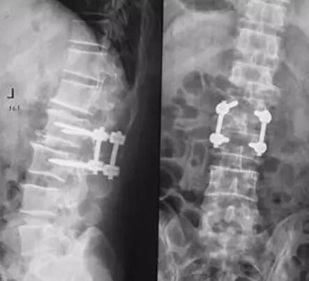 腰椎间盘突出6年前动过一次手术,现在又复发了,现在还能再动手术吗