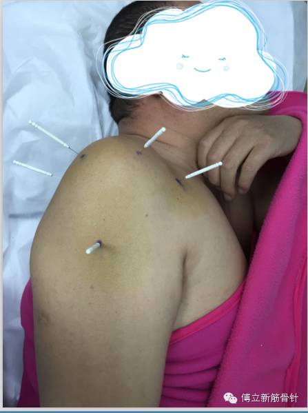 中医筋骨三针法—肩周炎的克星