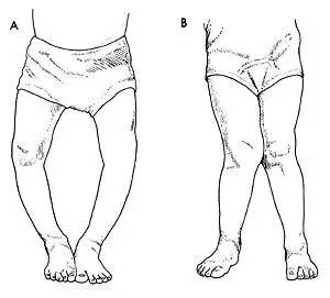 宝宝一岁半会走了会影响腿型吗_宝宝罗圈腿走路视频_宝宝罗圈腿