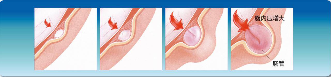如果嵌顿没有及时处理,卡住的肠管发生了坏死,那时就称为绞窄性疝.