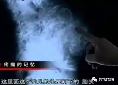 惊呆!九旬老太当年无钱手术引产,腹中的胎儿竟存在58年