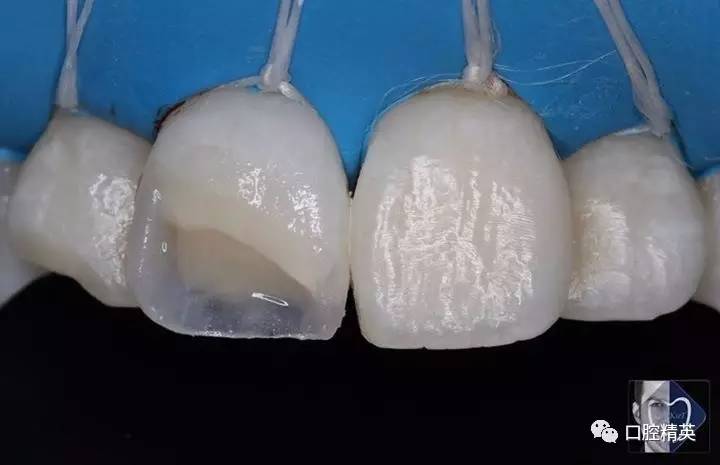 图解:前牙美学树脂修复1例