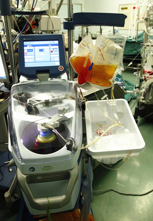 技术派|自体血液分离技术助力心脏主动脉手术