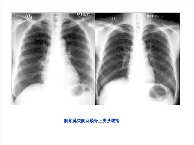 照片名称:胸锁乳突肌和锁骨上皮肤皱褶