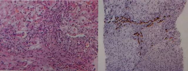 he&银染色:假小叶形成,假小叶内淤胆明显,纤维间隔内大量炎症细胞浸润