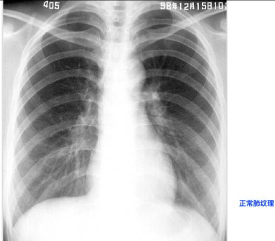 照片名称:正常肺纹理