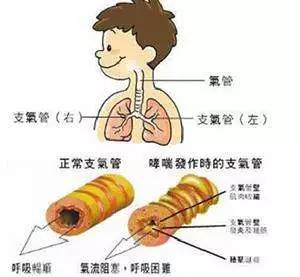 发绀 鼻扇征(  ),三凹征(  )  两肺可闻及喘鸣音及湿罗音 呼吸快