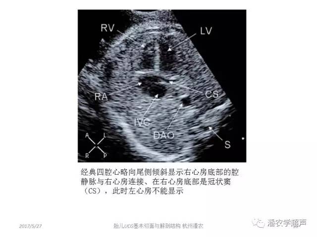 【超声微课堂】胎儿超声心动图基本切面与解剖结构的学习:四腔心标准