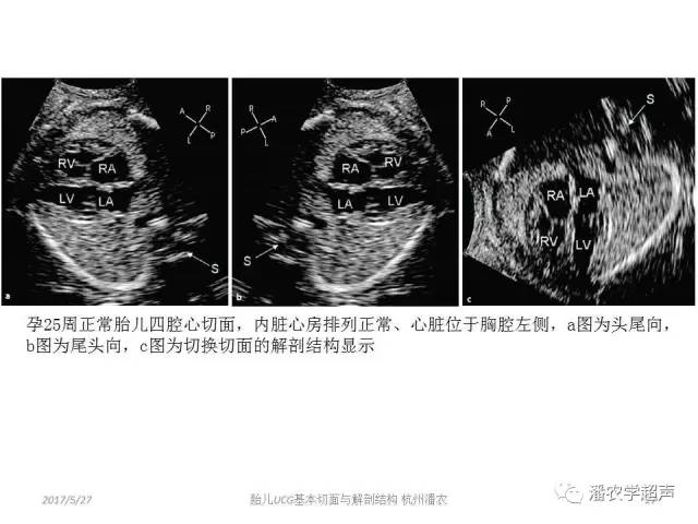 【超声微课堂】胎儿超声心动图基本切面与解剖结构的学习:四腔心标准