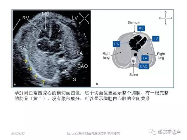 【超声微课堂】胎儿超声心动图基本切面与解剖结构的学习:四腔心标准