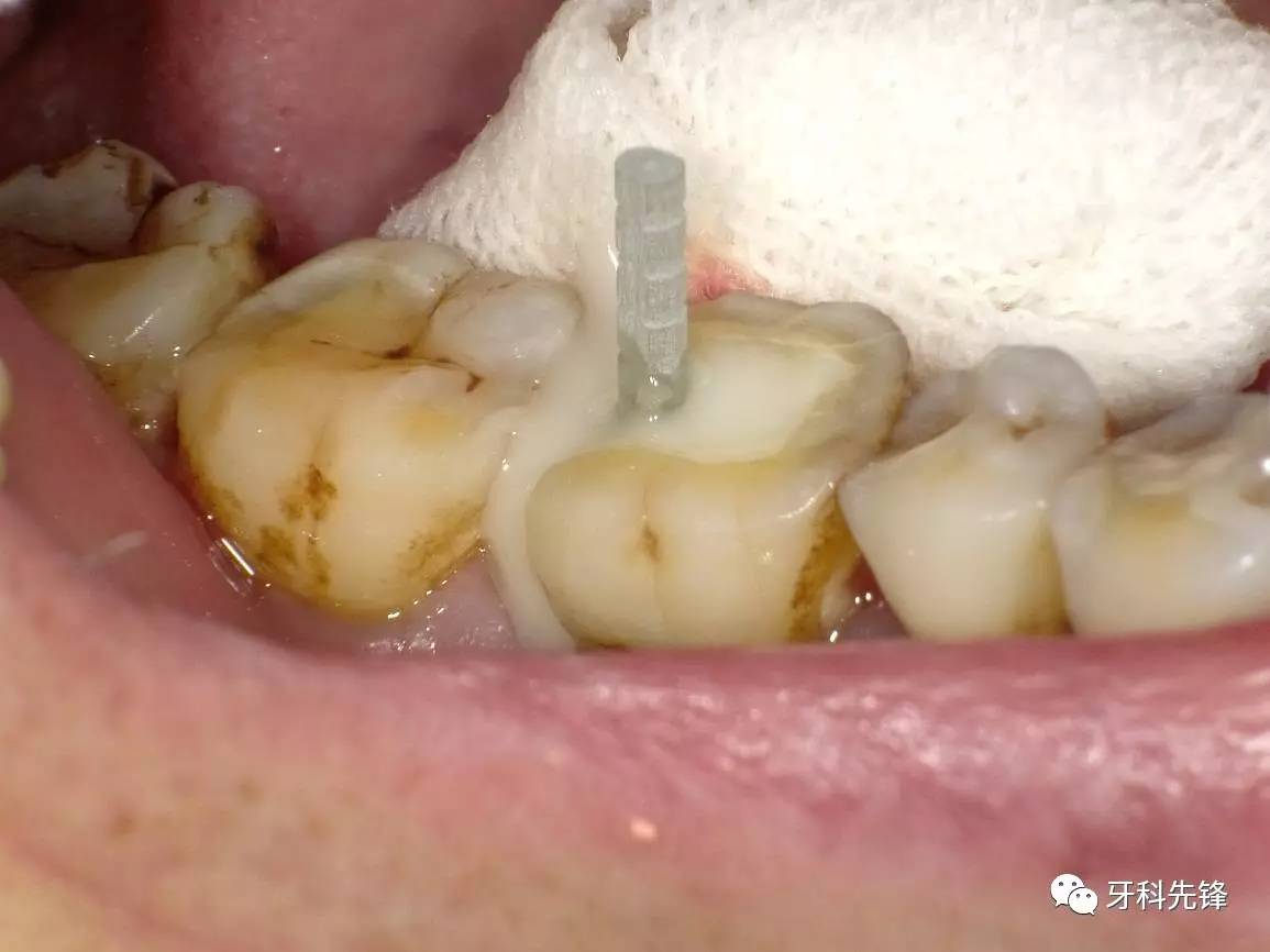 纤维树脂桩核临床应用技术关键点