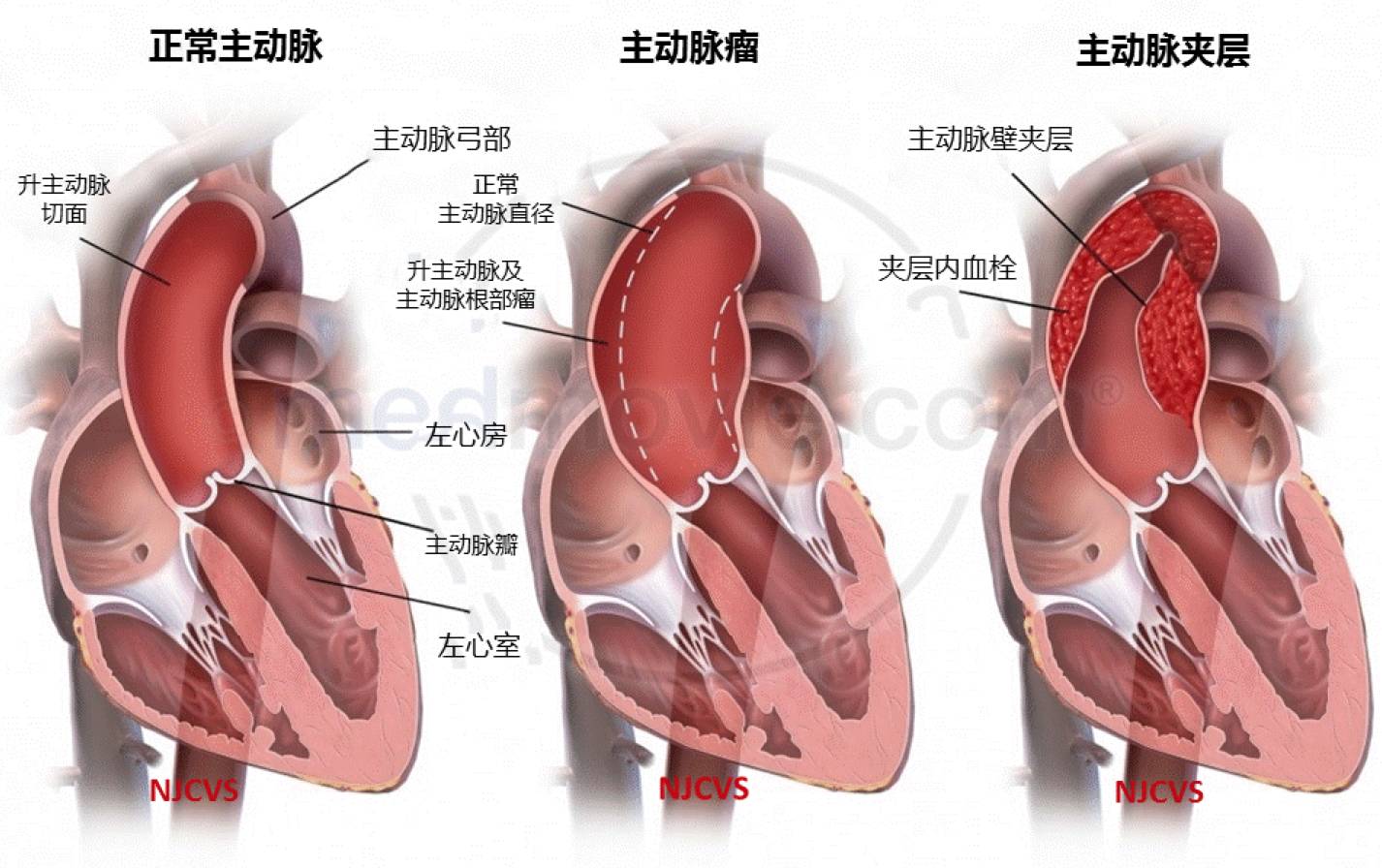 球囊扩张手术治疗右肺下动脉完全闭塞的大动脉炎