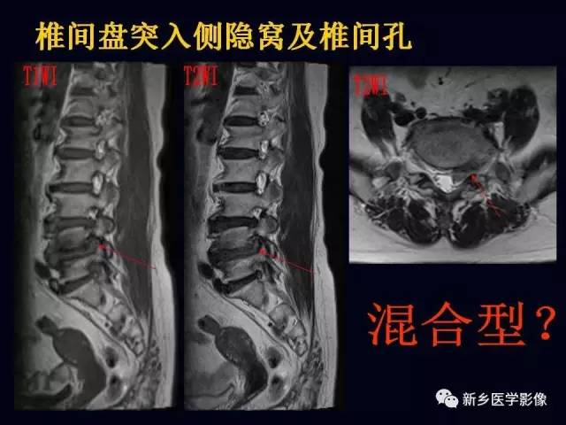 一文读懂椎间盘突出的解剖要点