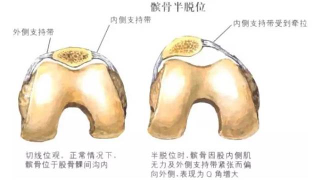 髌骨恐惧试验(patellar apprehe膝关节疼痛你需要想到这22种疾病