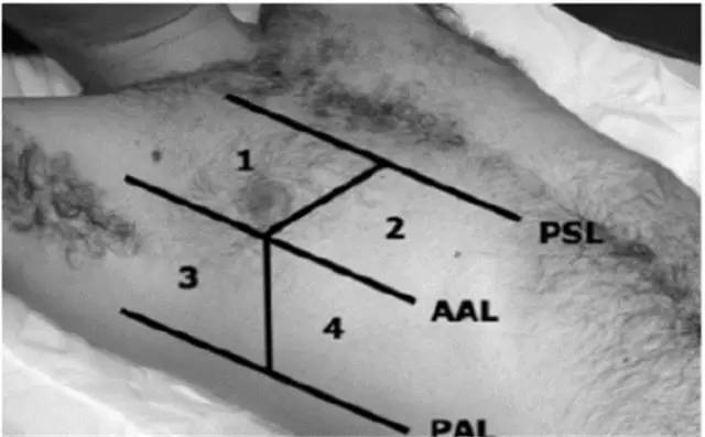 31单侧胸壁分为四区(psl胸骨旁线;aal腋前线;pal腋后线)