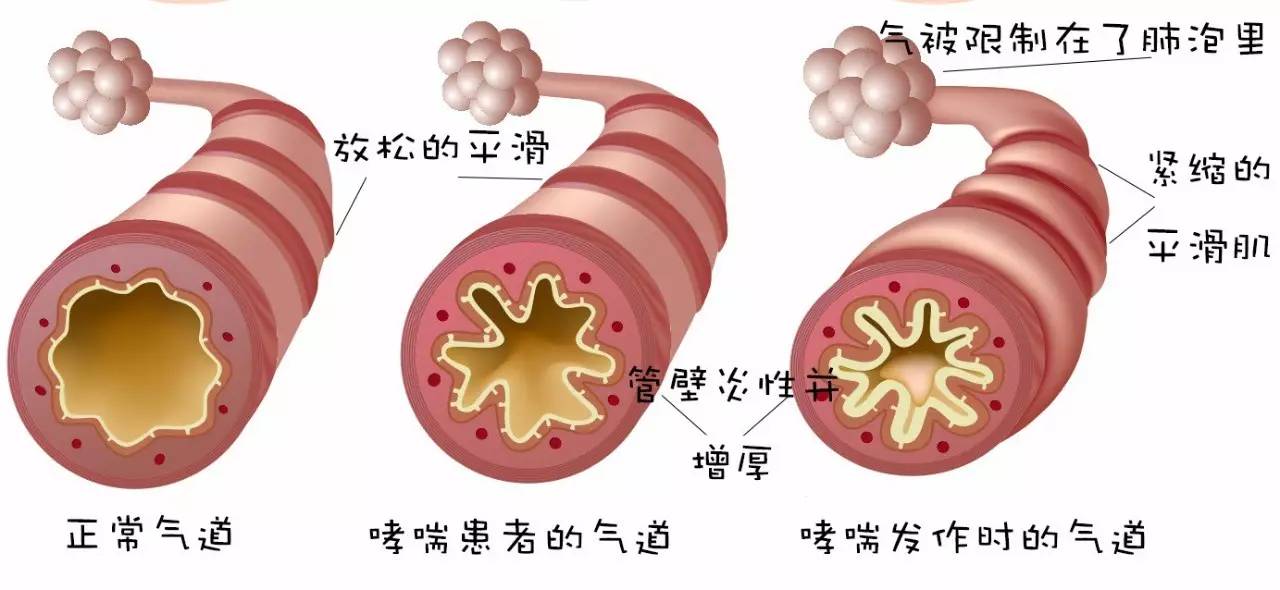 弄不清哮喘发病的机理没关系,只要记住哮喘发作的样子.