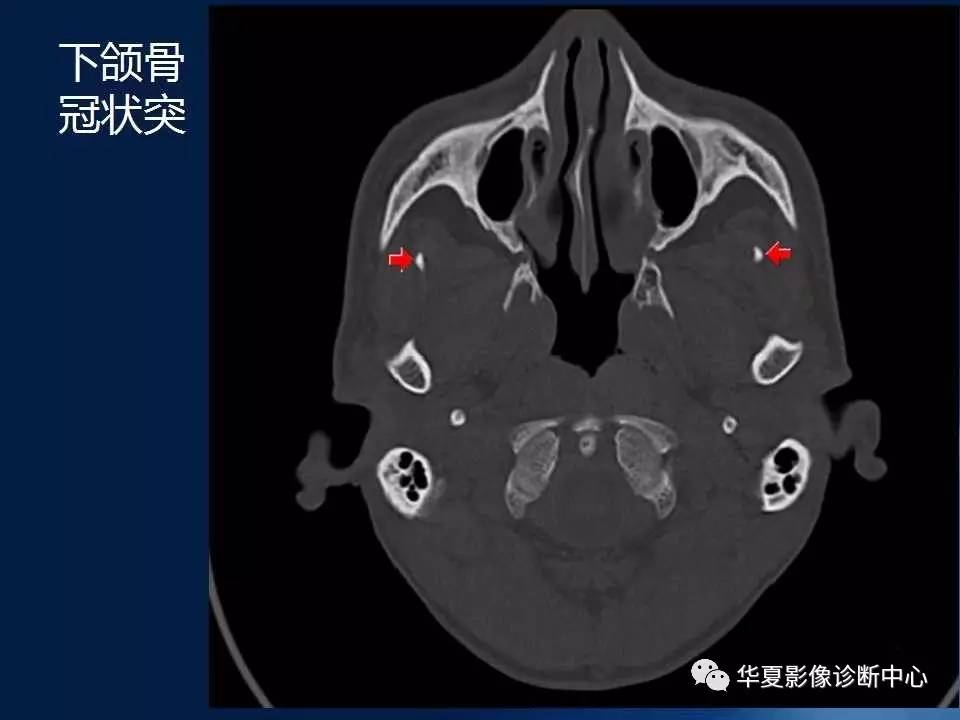 【影像基础】颅底骨质解剖