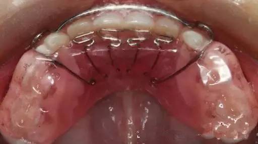 双曲舌簧是口腔活动矫治器作用力部分最常用装置之一,可使牙齿产生向