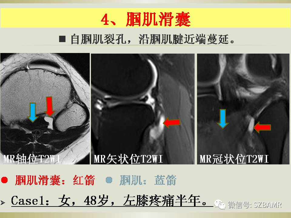 膝关节滑囊影像解剖与病变