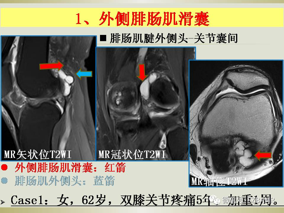 膝关节滑囊影像解剖与病变