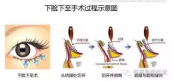 手术从结膜入路,切除下睑的睑板下缘,然后缝合