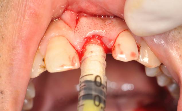一例左上1拔牙窝保存后种植修复病例