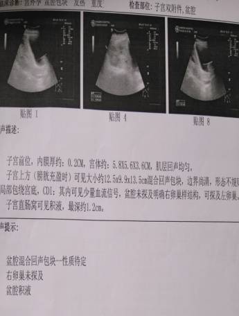 病例分析 | 陈旧性宫外孕一例