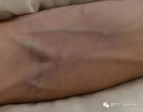 三,胸腹部青筋:乳腺增生,肝硬化