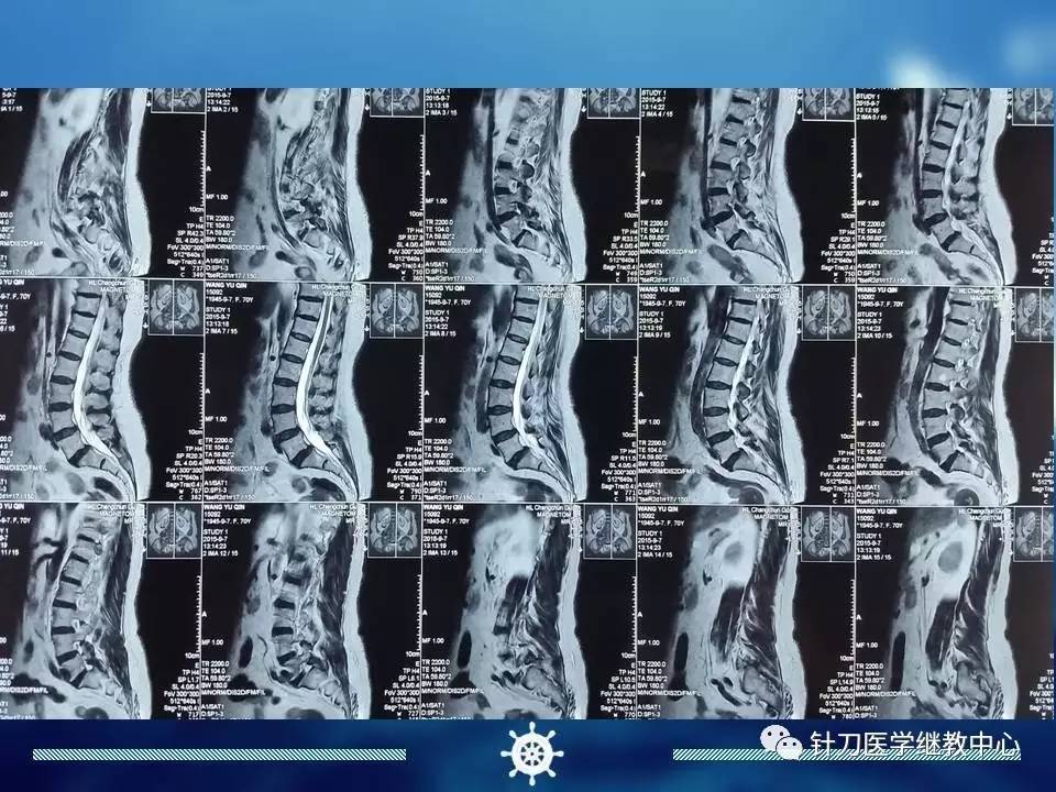 针刀微创诊疗梨状肌综合征思路病例分享(图文并茂)