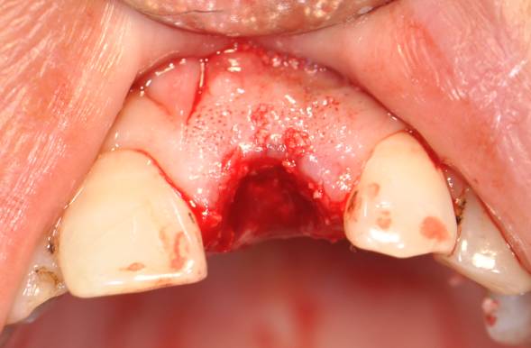 牙根拔牙前拍摄小牙片显示唇侧丰满度第一就诊时照片,颊侧有瘘管患者