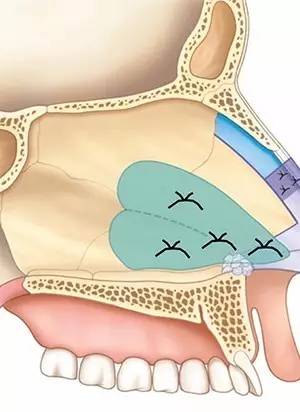 医美圈 | 【文献导读】一种新型鼻中膈夹板介绍
