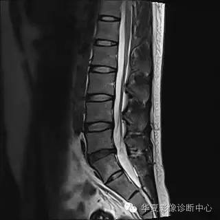 椎间盘软组织密度(信号)均匀向周围突出,硬脊膜囊受压,——椎间盘膨出