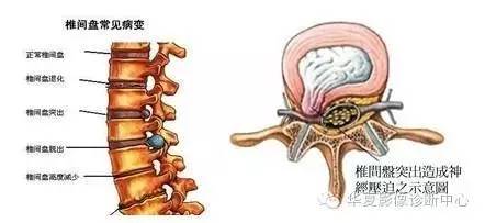 到底是椎间盘突出还是椎间盘膨出?报告中怎么报?