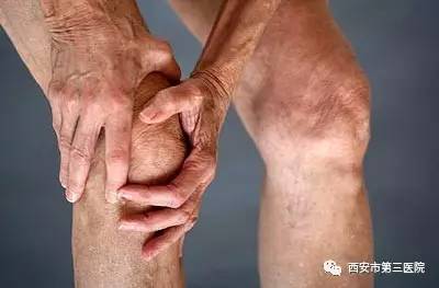 膝关节炎: 代表着膝关节的衰老,故称之为老年退行性膝关节炎.