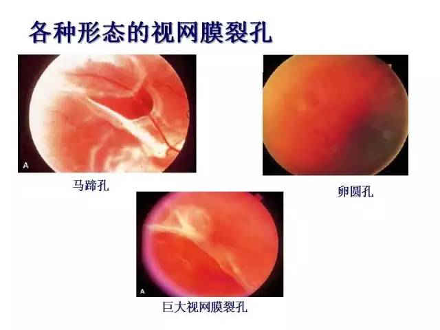 眼前出现黑点和闪光感?如何预防视网膜脱离!