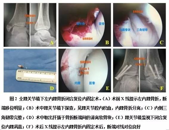 置入踝关节镜,探查踝关节腔,清除关节腔内的淤血,清理因骨折造成的