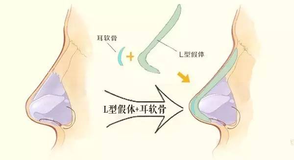 独家揭密：伪鼻综合整形的常见术式