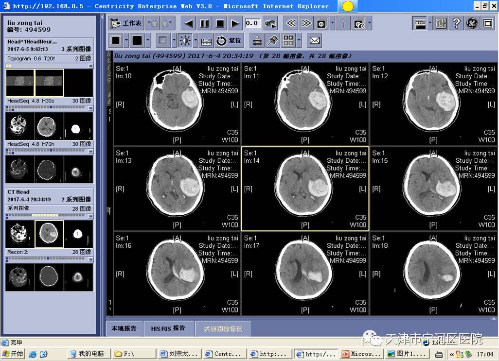 (术前急诊查头颅ct:左颞顶叶血肿较大,出血量约110ml,左侧脑室受压