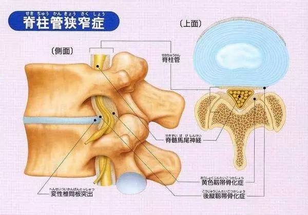 结果,椎体之间的椎间盘随移位的椎体突入椎管,而椎体后缘的后纵韧带