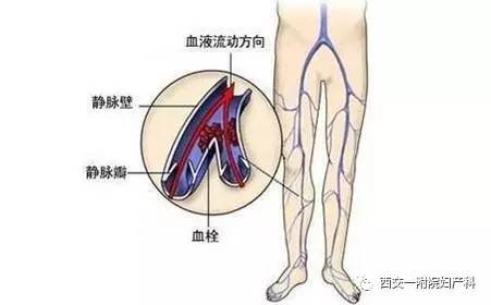 妇科手术后下肢深静脉血栓的护理