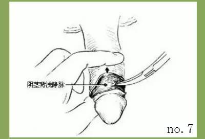 割包皮的过程是怎样的?