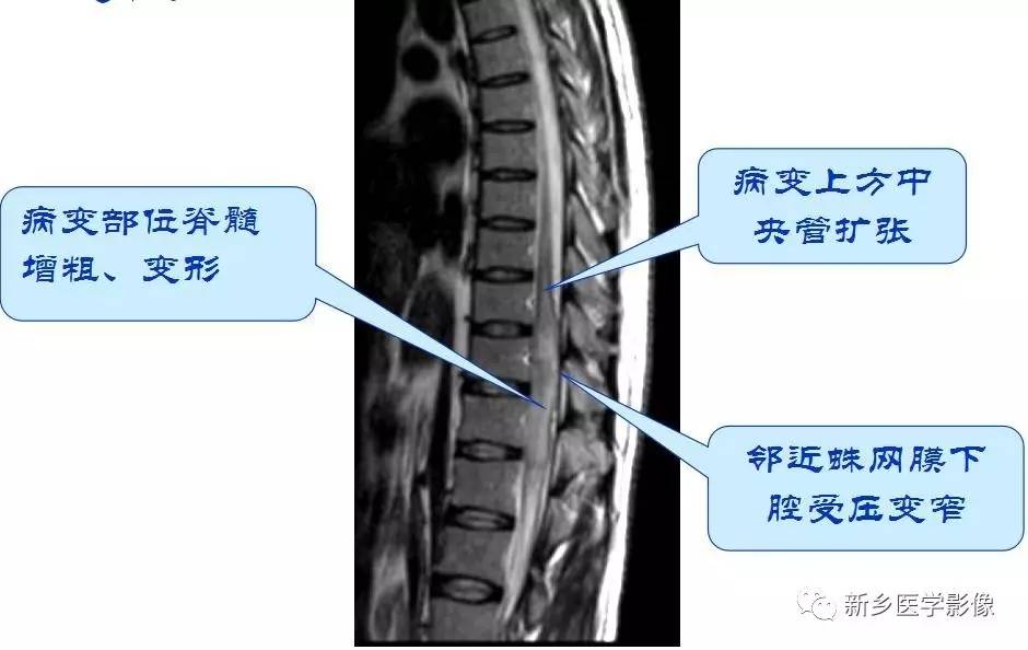 有了这张图轻松诊断椎管内占位