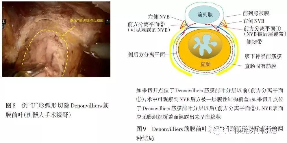 专题笔谈机器人和腹腔镜全直肠系膜切除术中denonvilliers筋膜解剖的