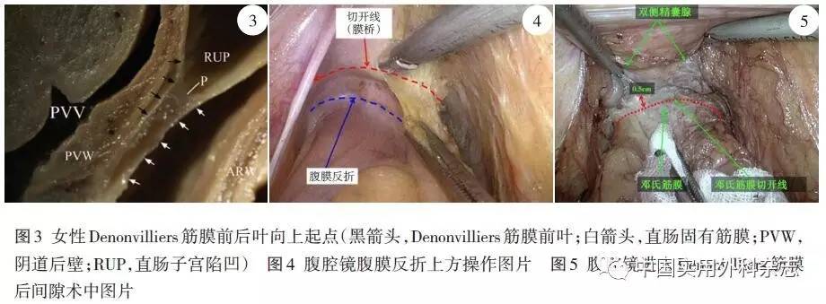 专题笔谈机器人和腹腔镜全直肠系膜切除术中denonvilliers筋膜解剖的