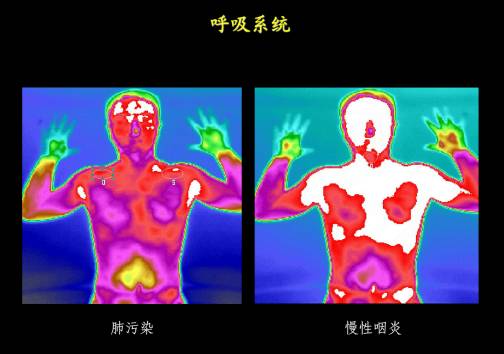 肿瘤筛查先行者,绿色体检新代表——热成像,到底神奇在何处?