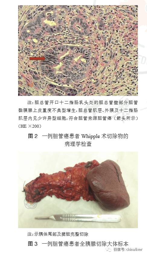 临床研究//全胰腺切除术治疗 whipple 术后胰腺断端