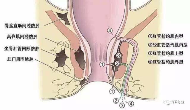 辨别:钻心样疼痛,并逐渐加重,伴发热,白细胞高,肛门周围慢肿,周边皮肤