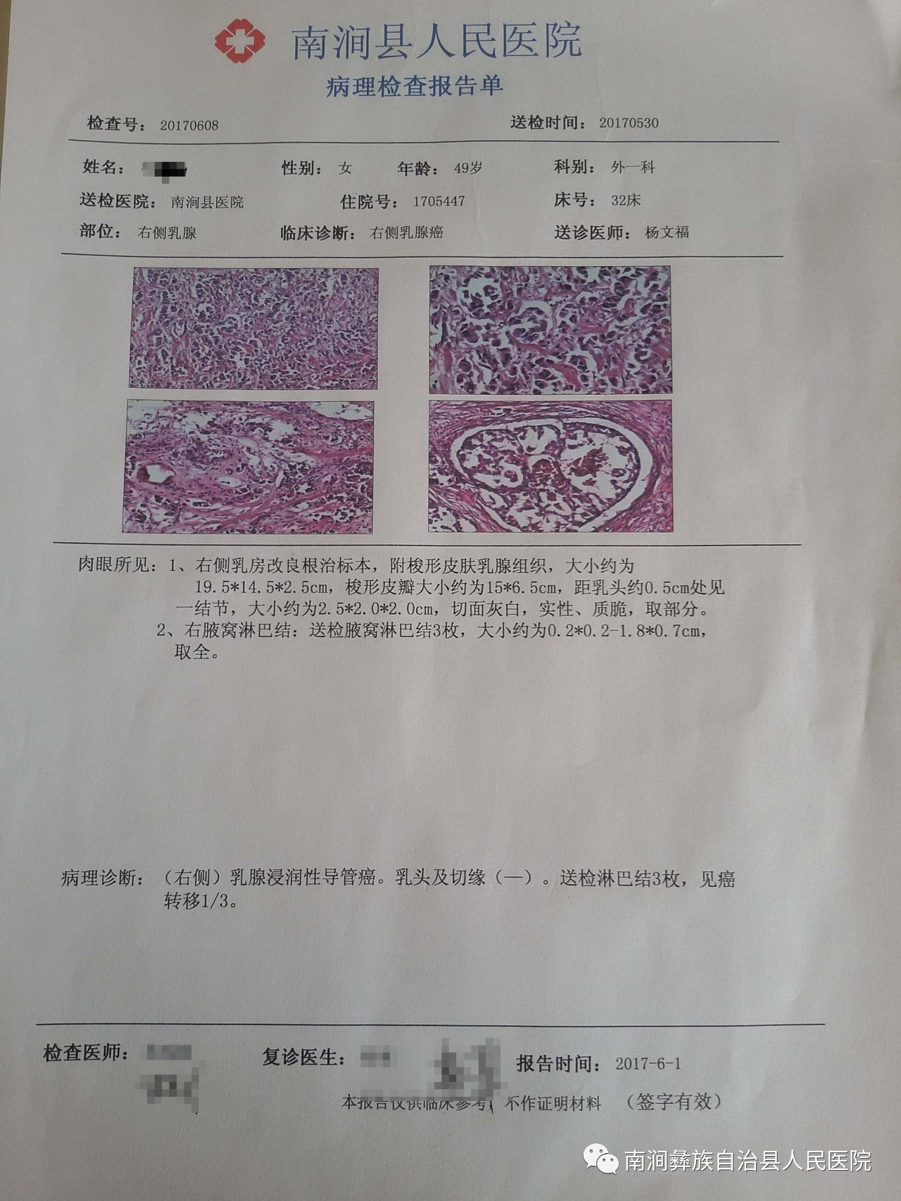 术后病理报告术后病理:乳腺浸润性导管癌,whoⅢ级,乳头及切缘,淋巴