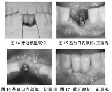 【病例分享】下颌前牙区种植治疗一例--改良前庭沟加深术加游离结缔